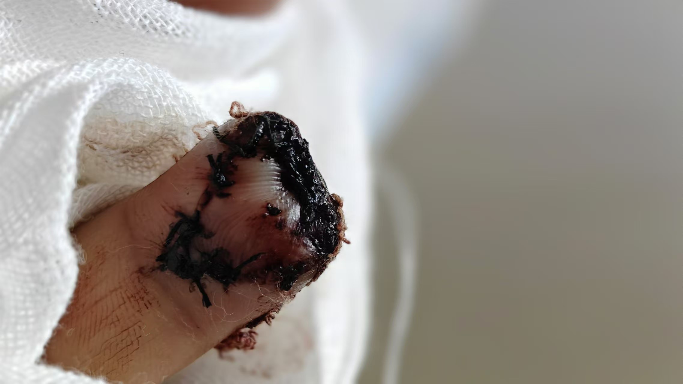 工伤.jpeg 工伤.jpeg